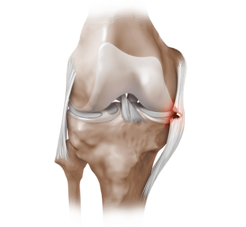 Collateral Ligament - MCL, LCL, PLC