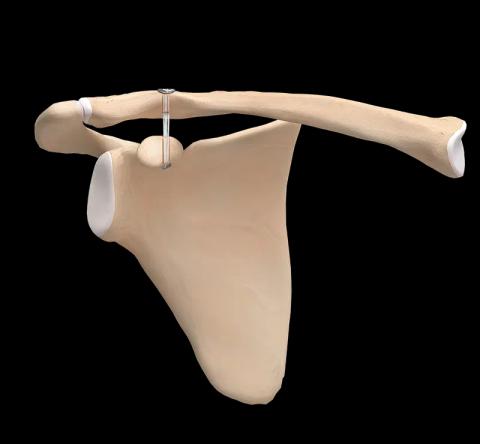 AC Joint Injuries