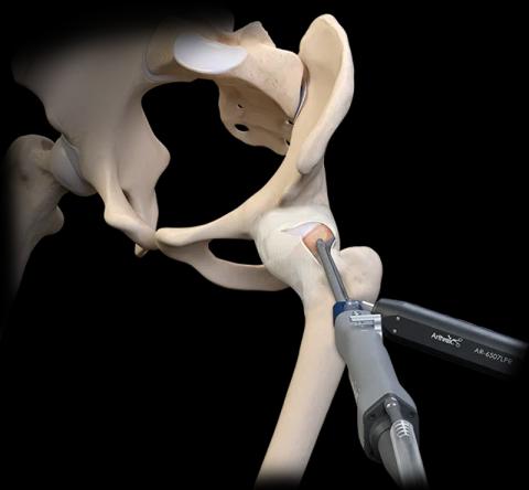 FAI (Femoroacetabular Impingement)