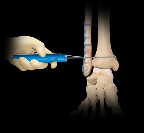 Syndesmosis and Ankle Fracture