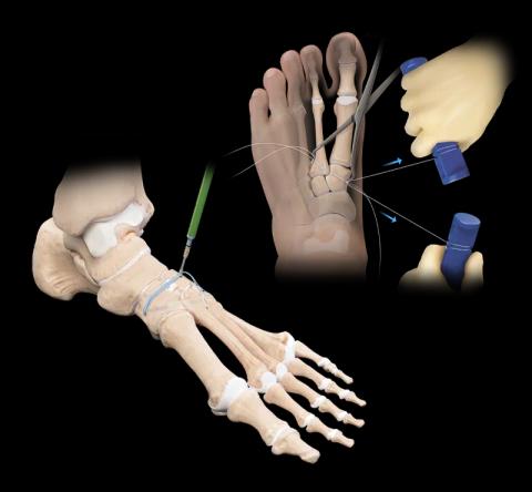 Lisfranc