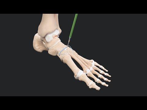 Thumbnail for Lisfranc Repair With the InternalBrace™ Technique: Indications, Rationale, and Outcomes