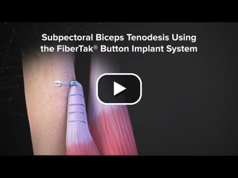 Thumbnail for Subpectoral Biceps Tenodesis Using the FiberTak® Button Implant System