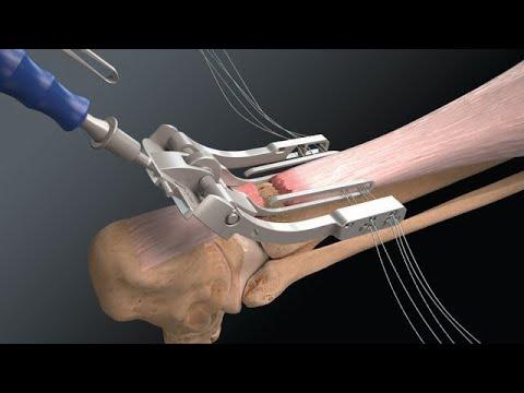 Thumbnail for What's New Top Video: Achilles Midsubstance SpeedBridge™ Implant System