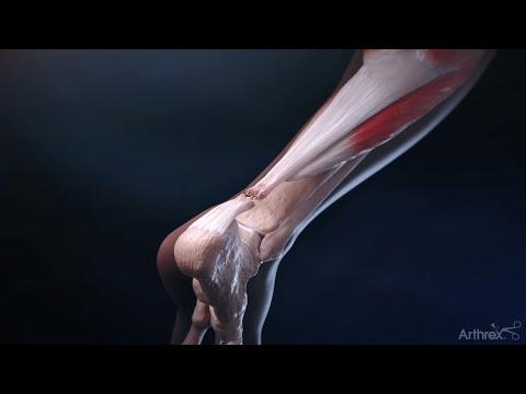 Thumbnail for Achilles Midsubstance SpeedBridge™ Surgical Technique