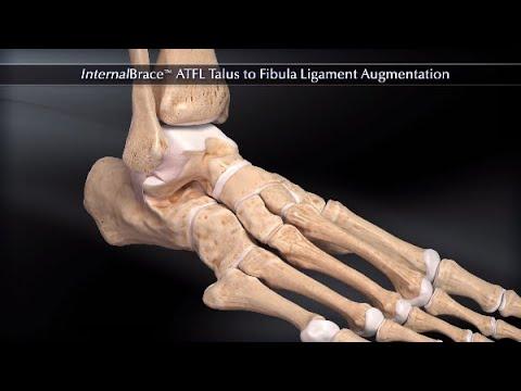 Thumbnail for InternalBrace™ ATFL Talus to Fibula Ligament Augmentation