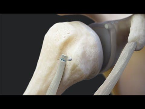 Thumbnail for Knotless FiberTak® Biceps Implant System for Proximal Biceps Tenodesis