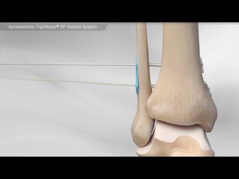 Thumbnail for Syndesmosis TightRope® XP Implant System