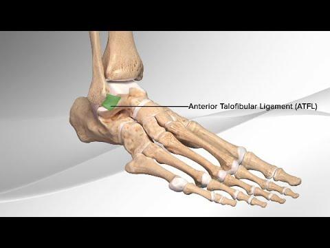 Thumbnail for Chronic Ankle Sprain Repair With the InternalBrace™ Ligament Augmentation Procedure