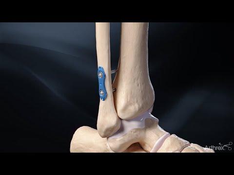 Thumbnail for Arthrex Syndesmosis TightRope XP Implant System