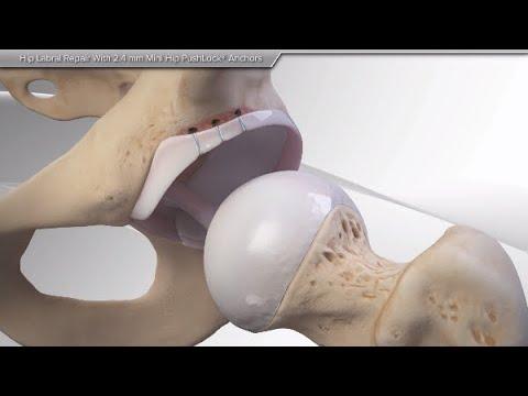 Thumbnail for Hip Labral Repair With 2.4 mm Mini Hip PushLock® Anchors