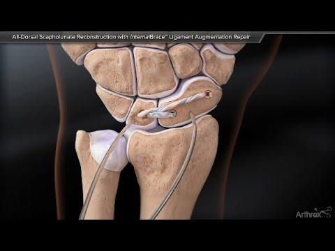 Thumbnail for All-Dorsal Scapholunate Reconstruction with InternalBrace™ Ligament Augmentation Repair