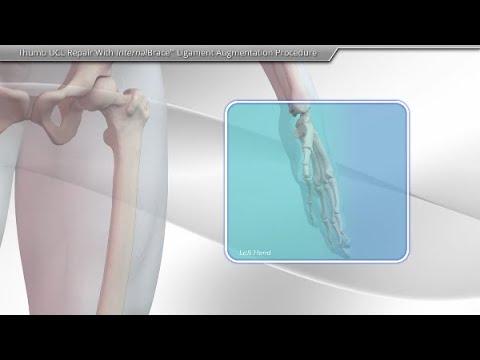 Thumbnail for Thumb UCL Repair With InternalBrace™ Ligament Augmentation Procedure